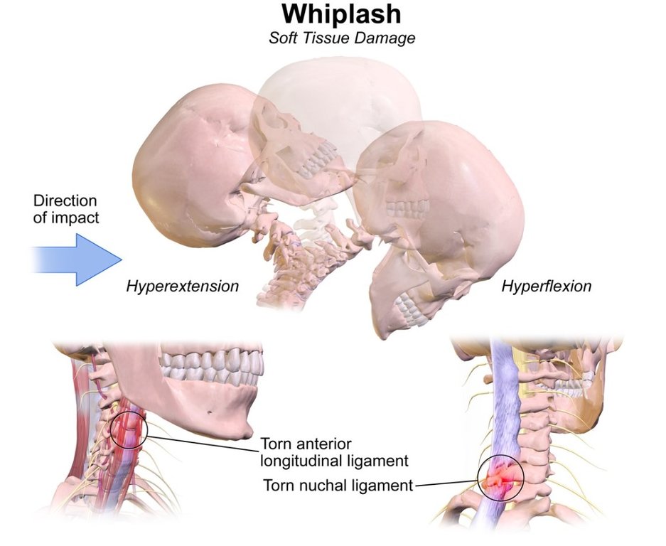 Whiplash diagram illustration