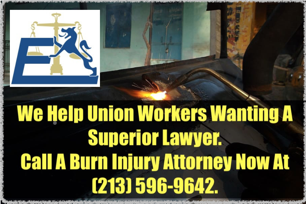 Union worker burns injury attorneys are here to help!